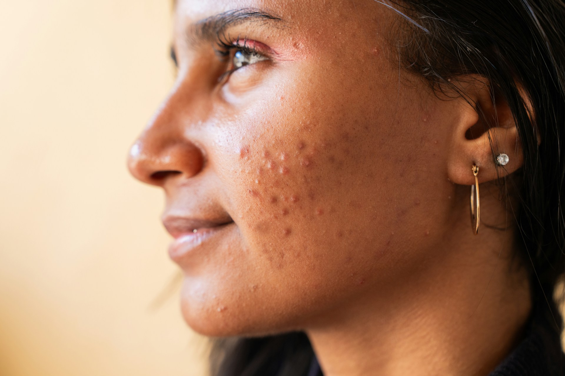 MelaMed Premium Wellness | Can Allergies Cause Acne? Understanding the Connection and Solutions